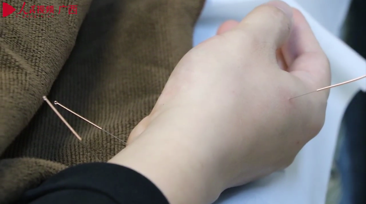 國壯體驗日：冠軍針灸手法，健康“針”給力