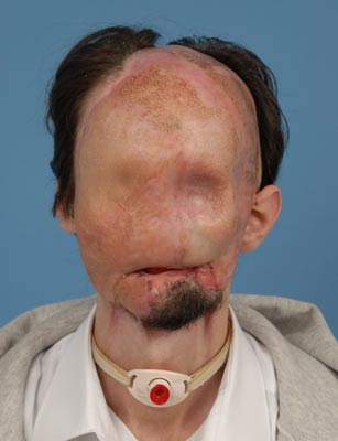 美国首次完成全脸移植术 无脸人告别无脸生